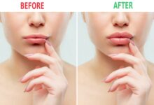 What is a lip flip​? Everything You Should Know